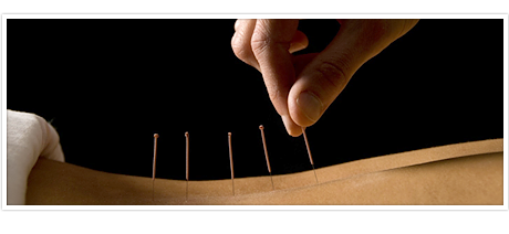 acupuncture